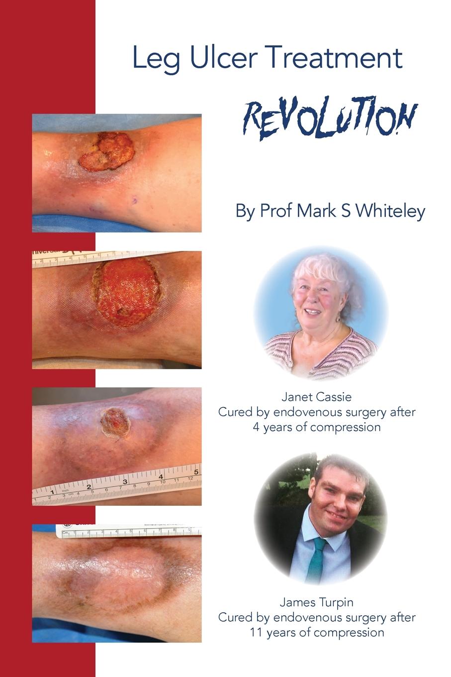 Leg Ulcer Treatment Revolution (Paperback)
