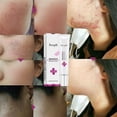 thumbnail image 3 of Limited time offer! Acne Extract Acne Removal Marks Facial, 3 of 9