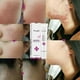 thumbnail image 3 of Acne Extract Acne Removal Marks Facial, 3 of 5
