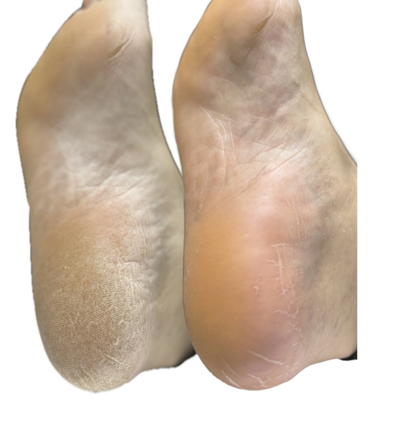 My2Feet Professional Electric Callus Remover+replacement Disks