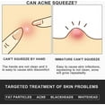 thumbnail image 5 of Professional Facial Milia Removal And Whitehead Extractor & Lancet - Double Ended Circle Loop & Sharp Needle Pimple Tool 2-in-1, 5 of 5