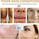 thumbnail image 4 of Crema de melasma, crema para manchas blancas, crema para eliminar manchas oscuras de melasma, elimina rápidamente el melasma, 4 of 5