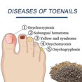 thumbnail image 4 of 96pcs Toenail Corrector Patches Ingrown Toenail Correction Stickers To Relieve Nail Groove Paronychia Treatment Patch Foot Care, 4 of 5