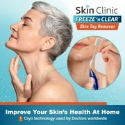 Skin Clinic FREEZE n CLEAR Skin Tag Remover