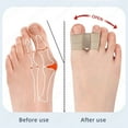 thumbnail image 3 of 2/4/6 Pcs Hallux Valgus Bunion Corrector Toe Separator Orthotics Feet Bone Thumb Adjuster Correction Pedicure Feet Straightener, 3 of 7