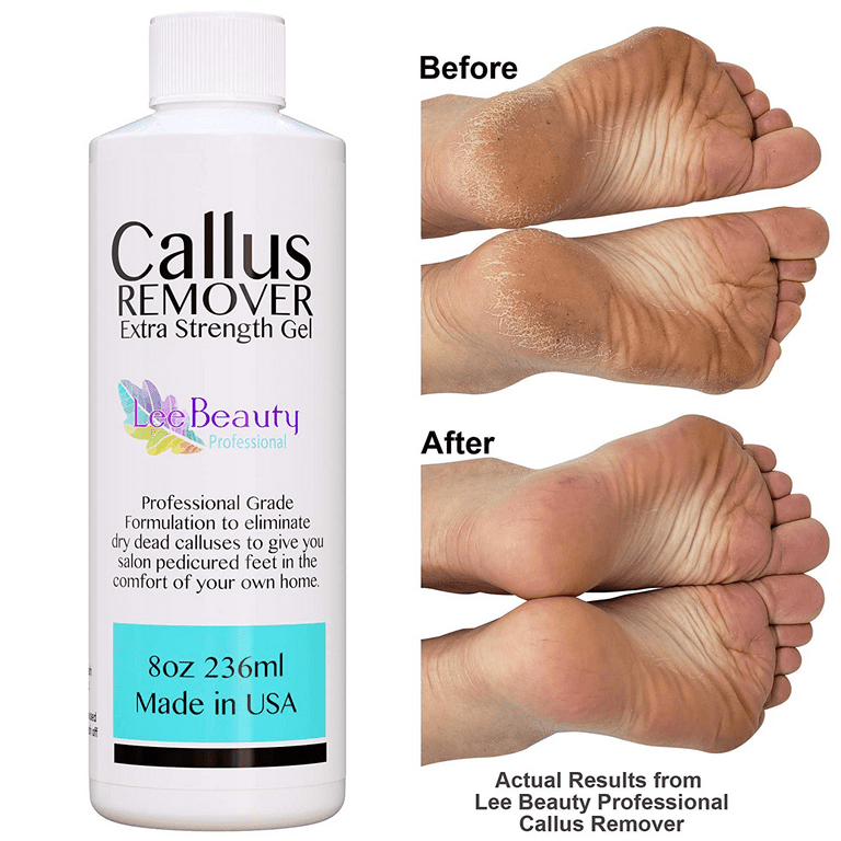 Callous Removers for Feet (8 oz), Made in USA | Callus Gel Remover - Best for Use with Foot File, Pumice Stone, & Foot Scrubber, Fast Acting Formula