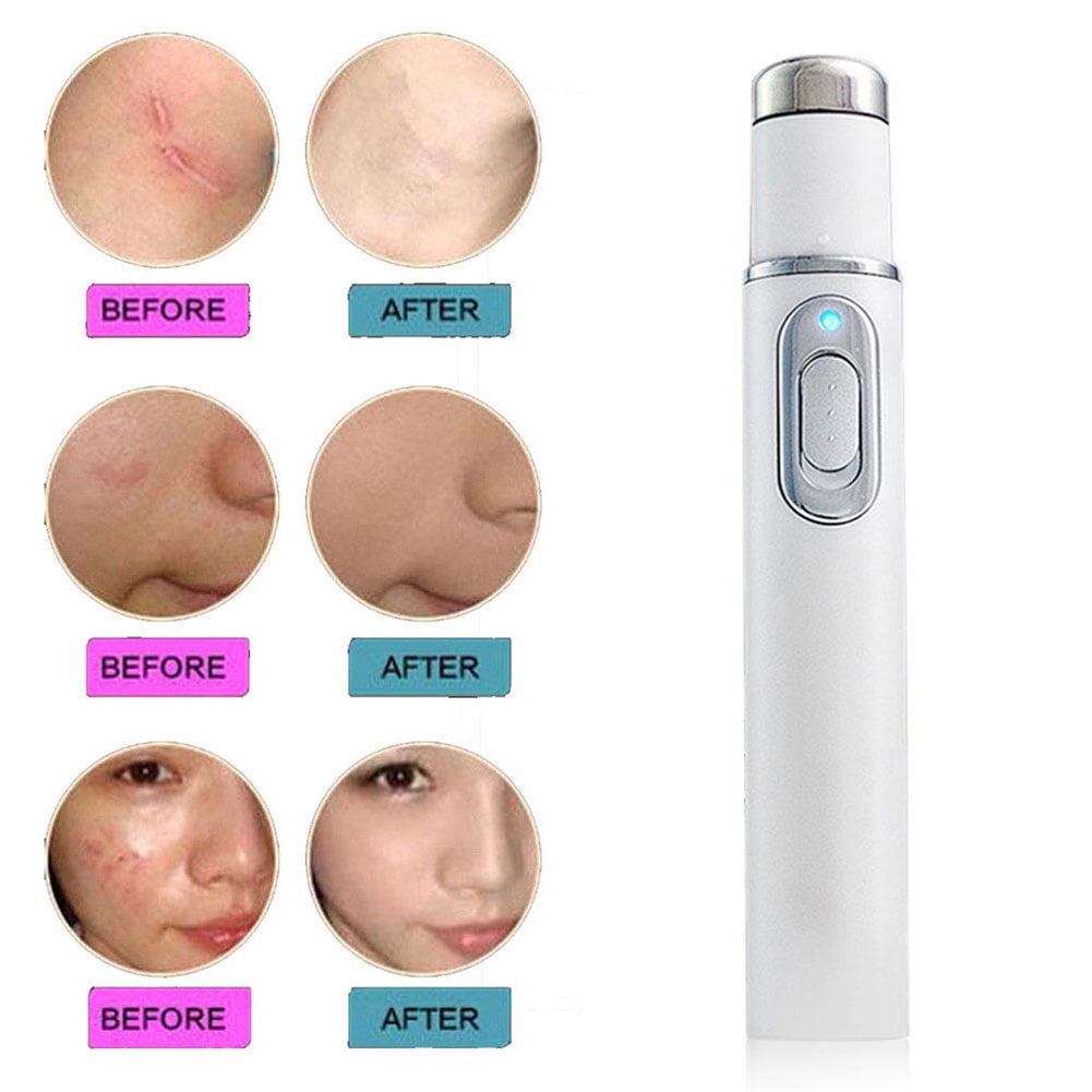 Portable Therapy Blue Light Wrinkle Removal Scar r Acne Pen KD-7910