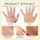 thumbnail image 4 of portable anti-itch cream for vitiligo skin care, 4 of 5