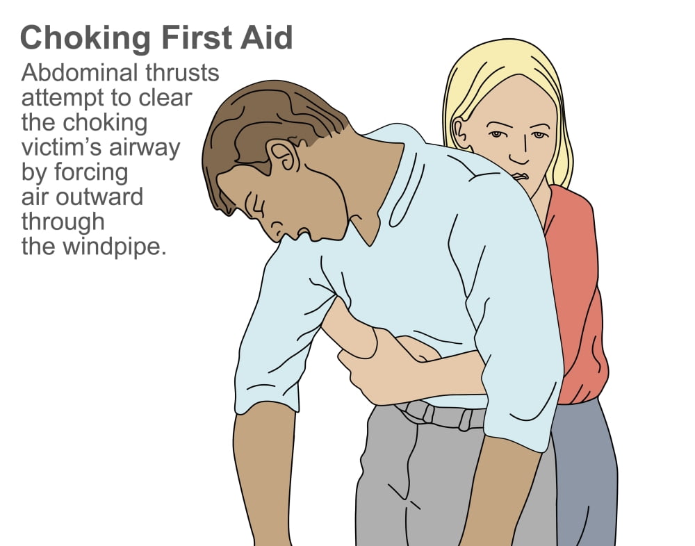 Heimlich Maneuver Poster Print By Gwen Shockey Science Source 24 X 18 Walmart Com Walmart Com Heimlich Maneuver Poster Print By Gwen Shockey Science Source 24 X 18 Walmart Com Walmart Com