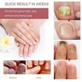 thumbnail image 4 of 2PCS 30/20ml Fungal Nail Repair Liquid Nail Treatments For Thicken Soft Nails Anti Infections, 4 of 5