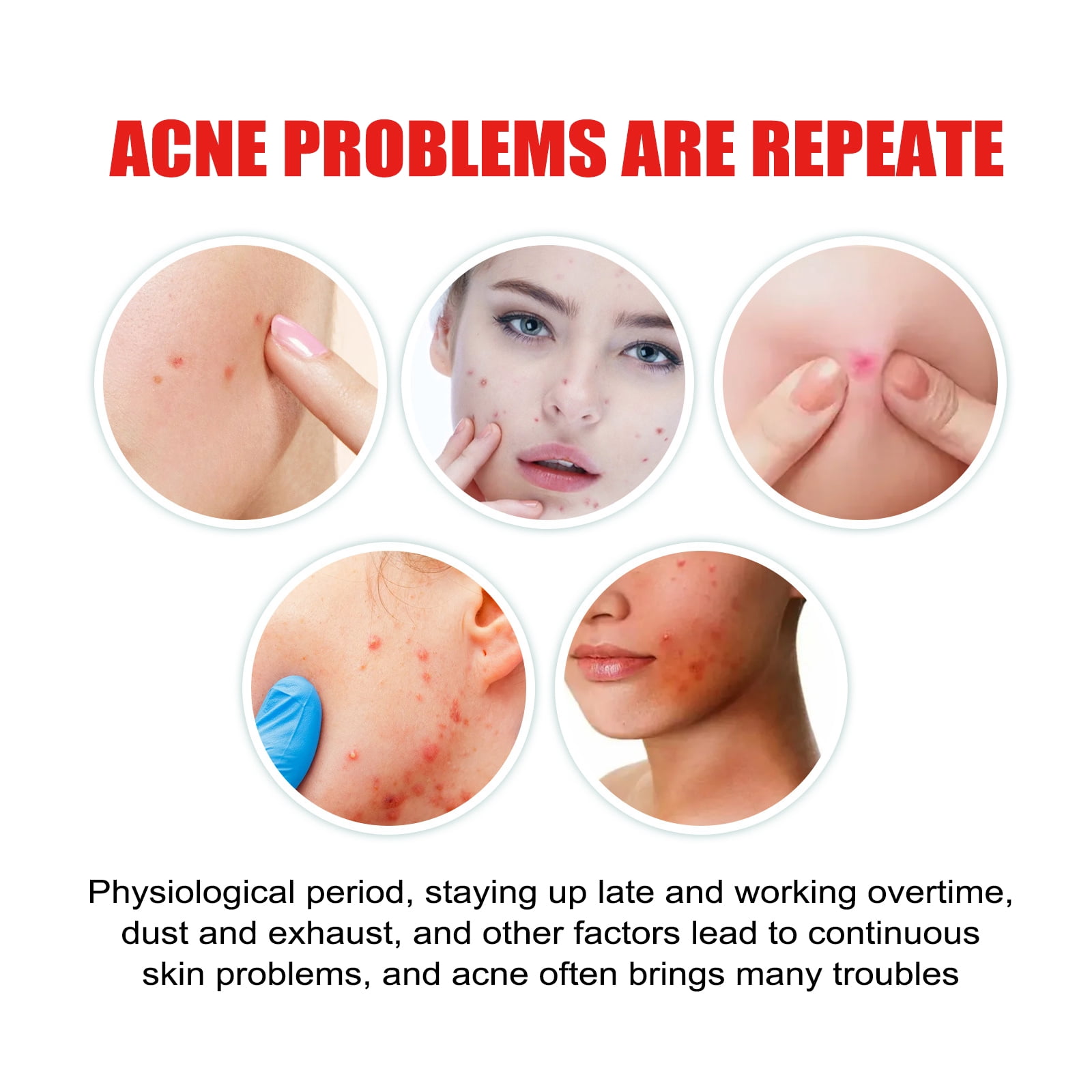 Alvantor Pimple Patches for Face with Tea Tree, Hydrocolloid Acne, Hurt Zit Covers, 200 Count