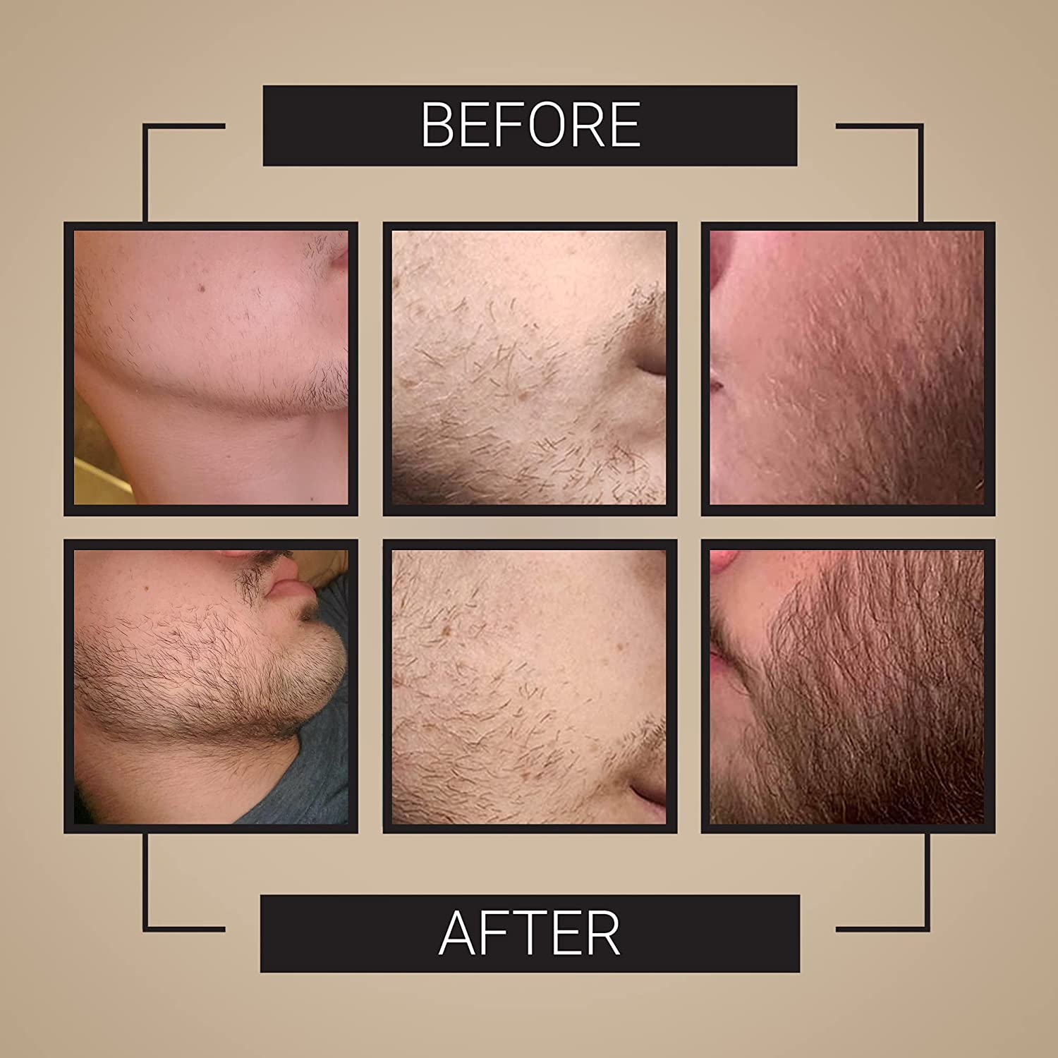 Derma Roller for Beard Growth + Beard Growth Serum - Stimulate Beard and Hair Growth - Derma Roller for Men - Amazing Beard Growth Kit - image 3 of 6