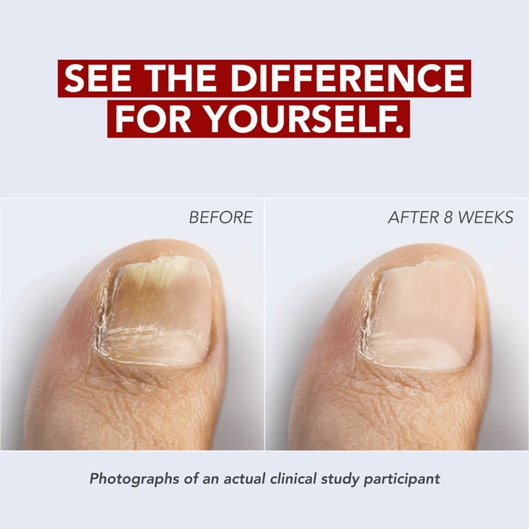 Kerasal Nail Fungus Extra Strength Repair photo 7