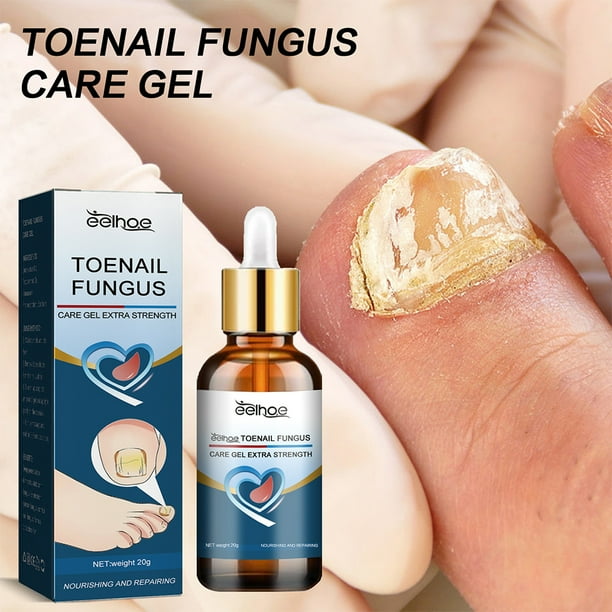 Gel crema para uñas onicomicosis Gel para eliminar hongos en las uñas productos para reparación de uñas de los pies