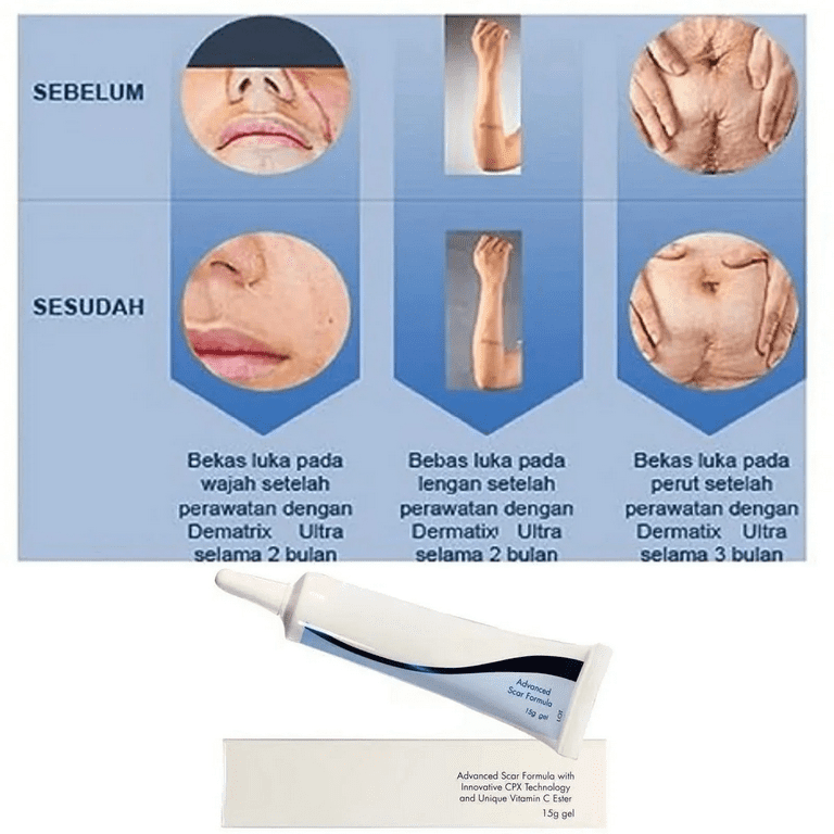Dermatix Ultra Advanced Quick-Dry Scar Gel, 15g - Visible Results