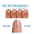 thumbnail image 4 of 4pcs Nighttime Fungal Nail Treatment Patch, Repair Hand And Foot Inlay Rotten Nails Thickening Gray Nail Polish Care Patch, 4 of 5