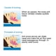 thumbnail image 1 of Dispositivo antirronquidos NikouMX grado profesional azul, 1 of 8