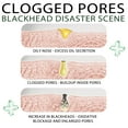The Truth About Big Blackheads And Pores: You Won'T Believe It! - zjjq3mc
