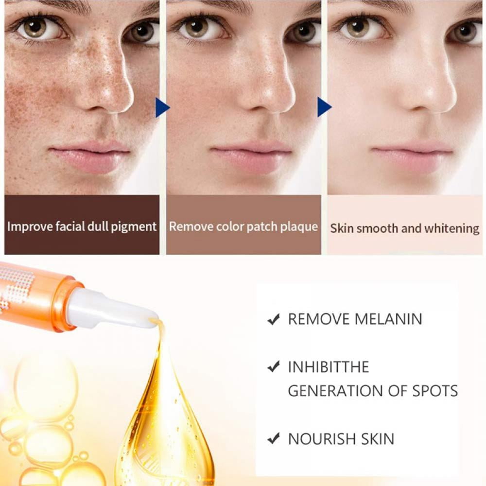 Buy Freckle Remover Cream, for Face Melasma Treatment Fade Cream with