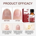 thumbnail image 5 of Nail Health Treatment Liquid for Growth, Strengthening Hardener for Peeling Nails, Antifungal Formula for Yellow Discolored Toenails – 15ml, 5 of 7