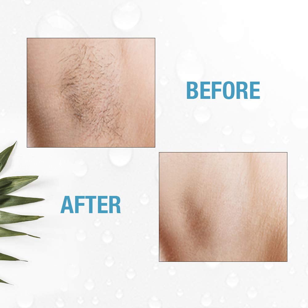 Clean and Easy Non-Laser Personal Electrolysis Facial Hair Removal Device for Flawless Face & Body