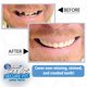 thumbnail image 3 of Carilla dental instantánea Secure Fit para dientes superiores, tono natural, 3 of 8