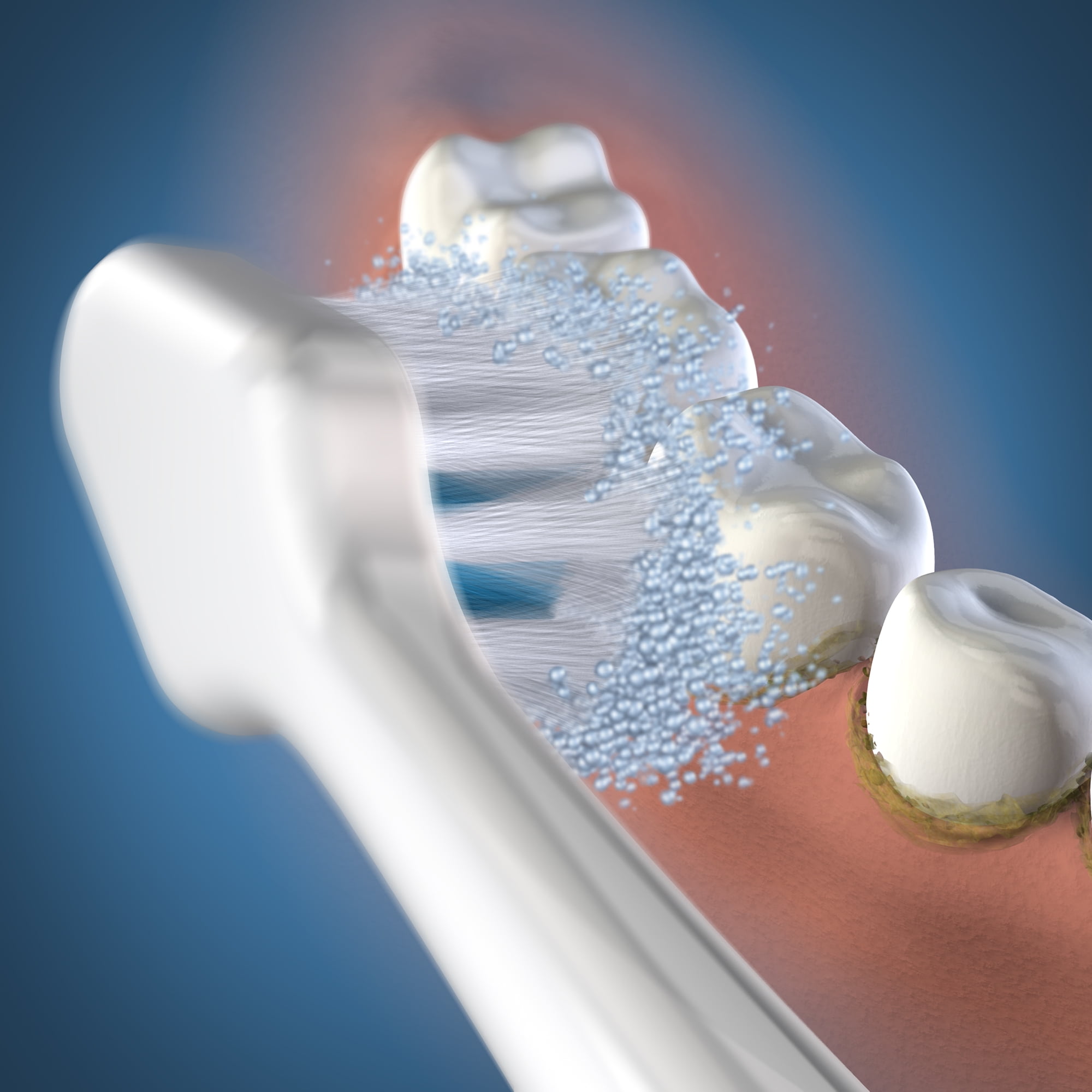 waterpik sonic 5.0 brush heads