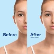 Differin Maximum Strength Acne Foaming Cleanser Face and Body Wash with 10% Benzoyl Peroxide, Fast-Acting Acne Treatment, 5 oz