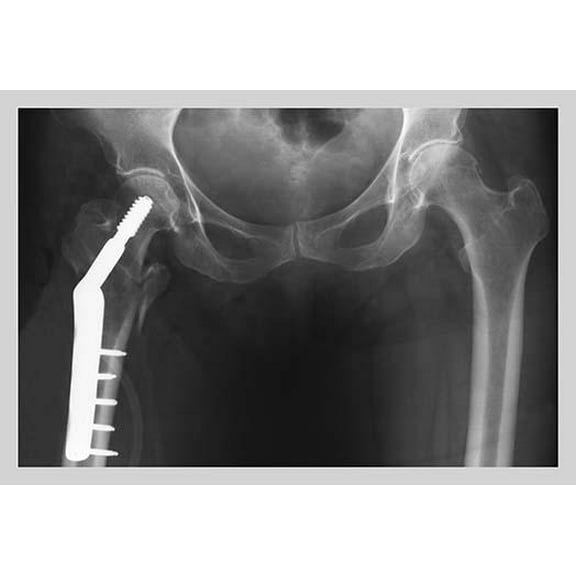 Femur Repair-Fine Art Canvas Print (20" x 30")