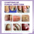 thumbnail image 4 of Toenail Fungus Care, FastActing Nail Care Liquid For Fungus Under & Around Restores The Healthy Appearance Of Nails 100ml, 4 of 9