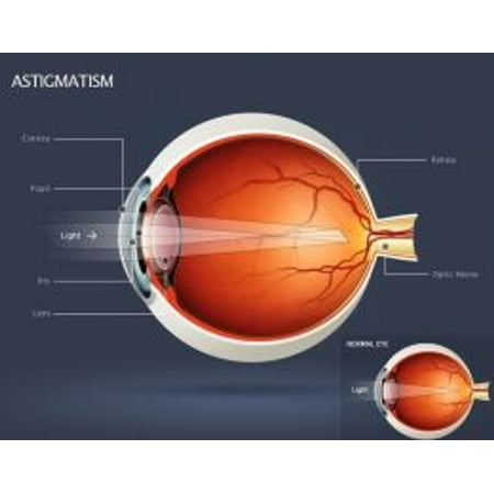 Astigmatism: Causes, Symptoms and Treatments - (Best Treatment For Astigmatism)