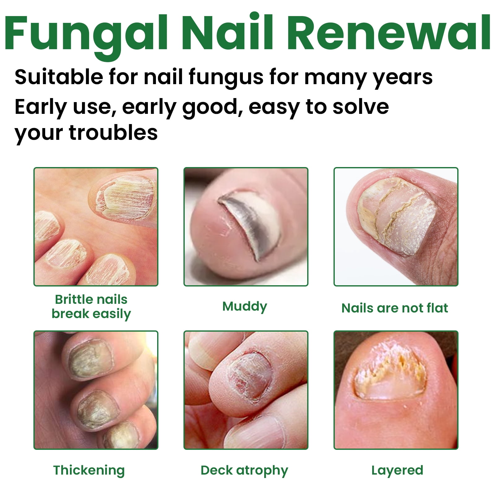 Alvantor Nail Repair For Fungal Treatment, Gray Removing Nourishing Lotion For Hands and feet, 1 fl oz