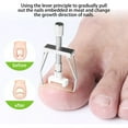 thumbnail image 2 of Herramienta De Uña Encarnada Ecomeon Trimmer Profesional Alicates Uñas Encarnadas, 2 of 6