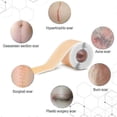 thumbnail image 5 of Silicone Scar Stickers Medical Silicone Easy-tear Gel Tape Roll Medical Grade, 5 of 5