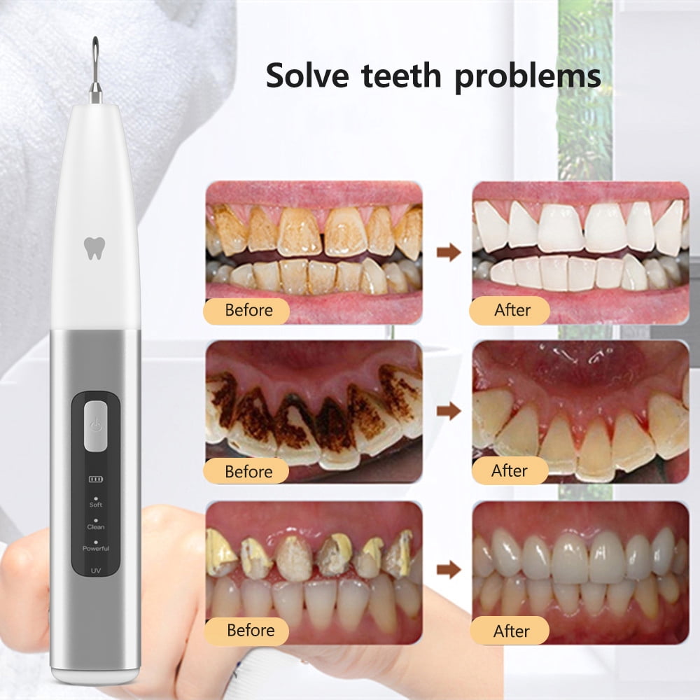 Ultrasonic Tooth Cleaner Electric Dental Calculus Remover Tartar Eliminator Dental Ultrasound Teeth Plaque Removal with UV Light
