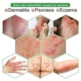 thumbnail image 3 of Ungüento para descamación de la piel, crema para aliviar la Psoriasis, Eczema bacteriostático, Urticaria, Dermatitis, tratamiento de rojeces, 1-3-6 uds., 3 of 4