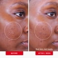 thumbnail image 4 of Almohadillas para el tratamiento del acné First Aid Beauty Maximum Strength 2% SA, 4 of 9