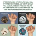 thumbnail image 2 of Ginger Nail Treatment,Multi-Purpose Nail Repair,Nail Nutrient Oil Strengthener Oil Serum Ginger Nail Growth Oil, 2 of 5
