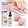 thumbnail image 3 of 2pcs Onychomycosis Rapid Relief Oil, Toenail Nail Treatment, Anti-Fungus Relief Oil, 3 of 5