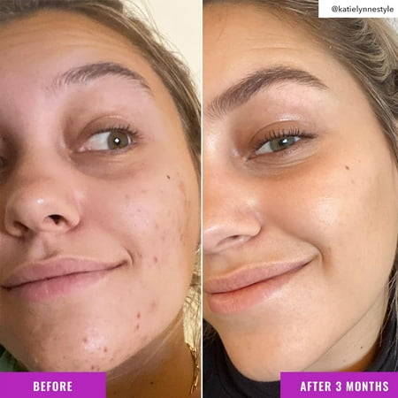 Good Molecules Brightening Toner 4 Fl. Oz! Formulated with Tranexamic Acid and 4% Niacinamide! Improves The Appearance of Age Spots, Acne Scars, Hyperpigmentation, and Sun Damage!