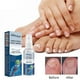 thumbnail image 2 of Antifungals Nail Treatments Spray In Medicals Quality, 30 Ml, Antifungals Nail Treatments, Antifungals Spray 30ml, 2 of 5