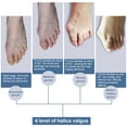 thumbnail image 2 of Ymiko Bunion Splints, Dynamic Pressure Bunion Corrector, For Male Female, 2 of 8