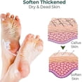 thumbnail image 5 of Foot Callus Removal Spray, Foot Heel Callus Remover Spray, Foot Peel Spray, 5 of 5
