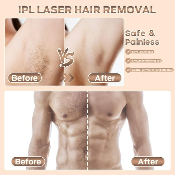 Depilación láser, depilación IPL en casa para mujeres y hombres