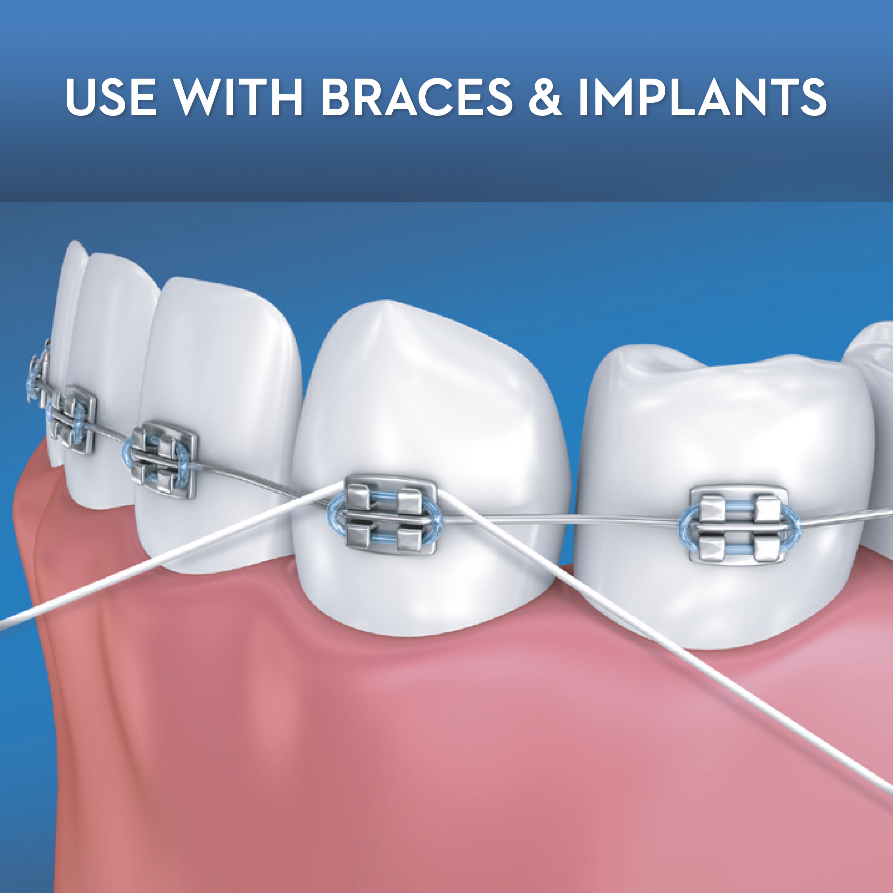 DentaGama on X: Superfloss can clean around braces, implants, bridges or  wide gaps. It consists of a stiff end, making it easy to insert between  braces and under retainers. Attached to the