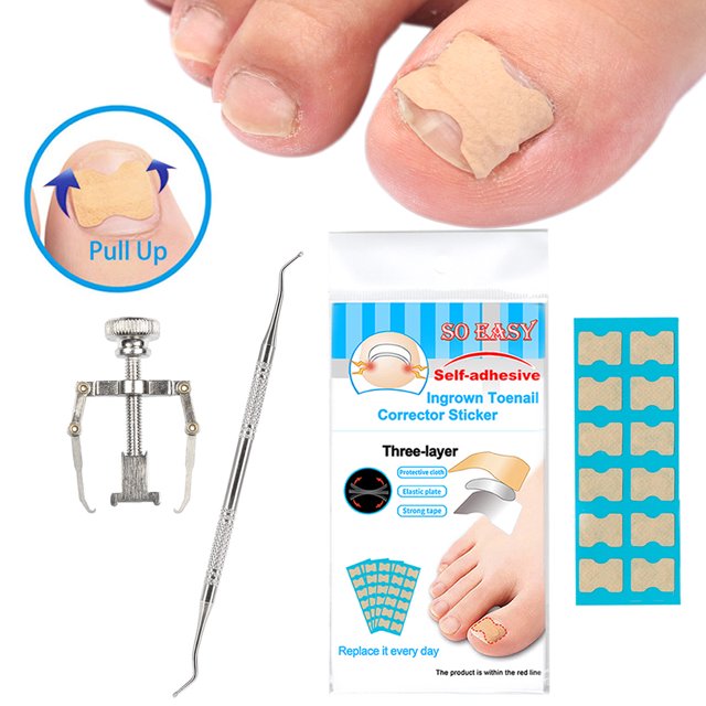Corrector de Uñas Encarnadas Sin Pegamento - Kit Profesional con 60 Parches, Separador y Pinza de Acero Inoxidable para Alivio Rápido del Dolor