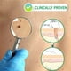 thumbnail image 3 of Removedor De Verrugas Aceite de eliminación de verrugas líquido de suero de eliminación de manchas oscuras de 20ml portátil para tratamiento facial Tmvgtek Cuidado Belleza, 3 of 9