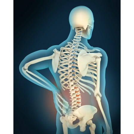 Back Pain Poster - Medical illustration showing inflammation and pain in human back area perspective view Poster Print