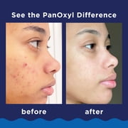 PanOxyl 10% Benzoyl Peroxide Acne Foaming Wash, Clear Acne, 5.5 Oz