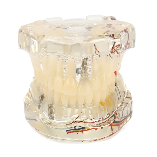 Modelo Patológico De Implante Dental, Modelo Patológico De Implante Dental Transparente Modelo De Dientes De Enfermedad De Implante Para Demostración De Enseñanza